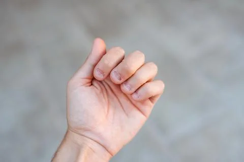A man's hand with bitten and ugly fingernails. Bad care of hands Stock-Fotos