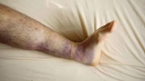 Bruises Stock Footage ~ Royalty Free Stock Videos
