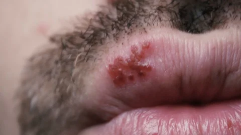 Man's lips with herpes. Front view Stock Footage 129464674
