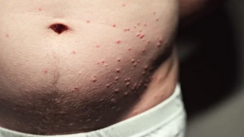On the man's stomach, are numerous small bumps visible, highly itchy, Stock Footage 244704385