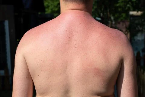 Man's sunburned back, sunburn, reddened skin, tan, rear view Stock Photos