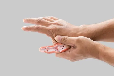 A man's thumb bone is broken. Stock Photos