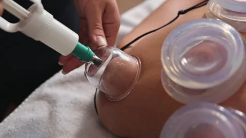 A manual cupping therapy technique where a practitioner applies suction cups on Vídeo Stock 344379372