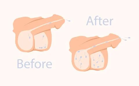 Many and few spermatozoa. Vector illustration of problems in andrology. For Stock Illustration