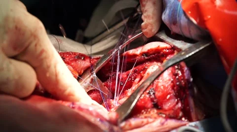 Many surgical sutures Stock Footage 61518776