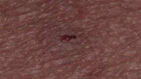 March or Horse Fly  Bite on human arm Video stock 150437029