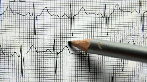 Marking different waves of an ECG 스톡 동영상 36475077