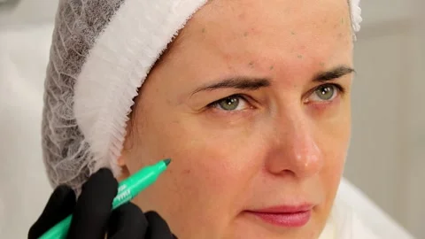 Marking the patient with a marker before the injection procedure Stock Footage 166115696