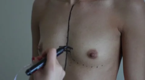 Marking before plastic surgery Stock Footage 68138343