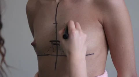 Marking before plastic surgery Video stock 68138421
