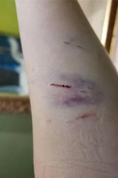 Marks and bruises on the arm. Stock Photos