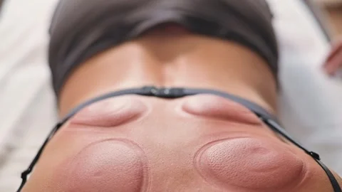 Marks on the back after vacuum therapy with cups Видео 344379464