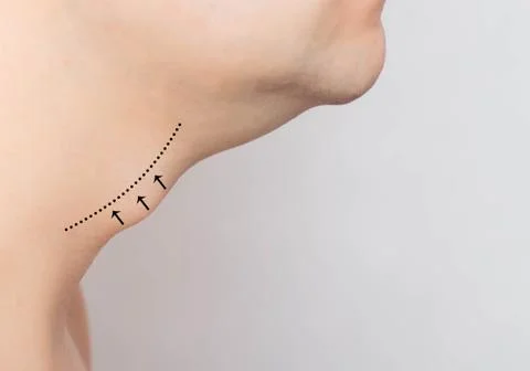 Marks in a man on an Adam's apple, reduction and removal of the Adam's apple in 库存照片