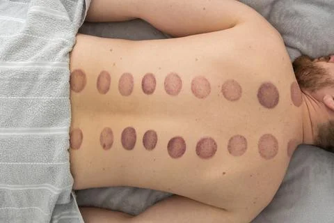 The marks on the man's back are large, deep purple, circular marks ecchymos.. Stock Photos