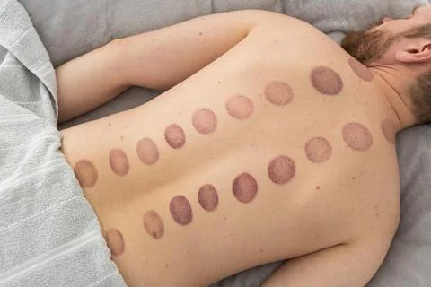 The marks on the man's back are large, deep purple, circular marks ecchymos.. Stock Photos