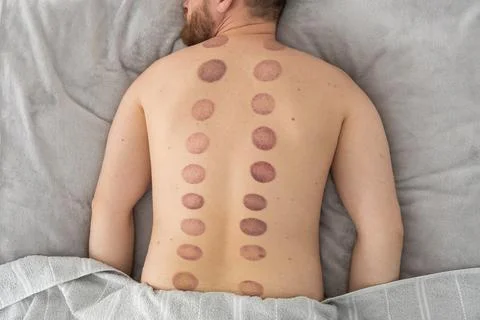 The marks on the man's back are large, deep purple, circular marks ecchymos.. Stock Photos
