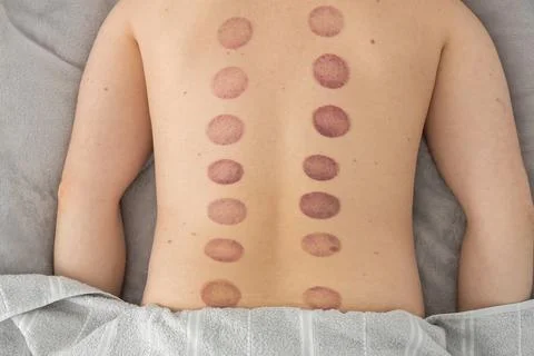 The marks on the man's back are large, deep purple, circular marks ecchymos.. Stock Photos