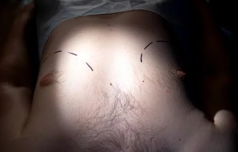 Marks on the man's chest about the correction of the man's breast. Breast Photos