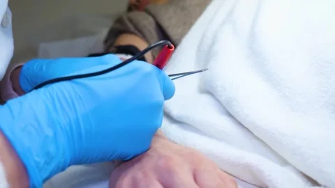 A master performs an electrodepilation procedure on a girl's arm Stock Footage 270173642