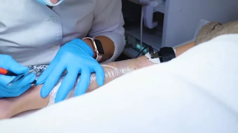 A master performs an electrodepilation procedure on a girl's arm Stock Footage 270173648