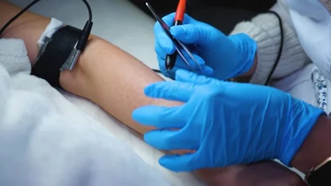 A master performs an electrodepilation procedure on a girl's arm Stock Footage 270173650