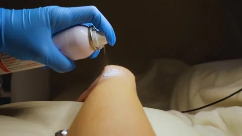 A master performs an electrodepilation procedure on a girl's arm Stock Footage 270173672