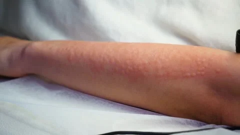 A master performs an electrodepilation procedure on a girl's arm Stock Footage 270173715