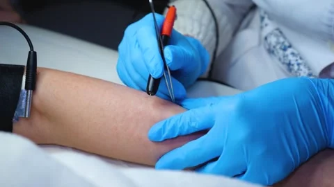 A master performs an electrodepilation procedure on a girl's arm Stock Footage 270173773