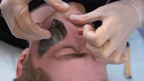 Master performs procedure removing unwanted facial hair in bearded man with wax Stock Footage 149482865