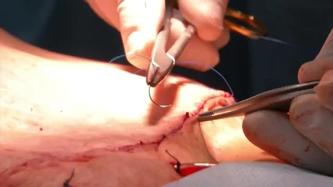 Mastership of the surgeon in the operation. Stock Footage 83191698