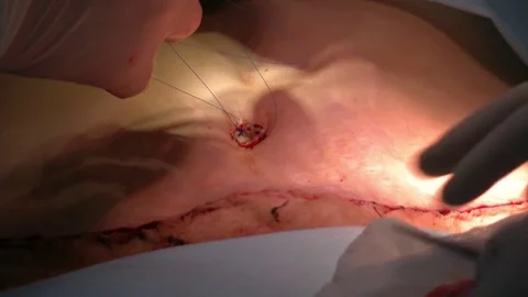 Mastership of the surgeon in the operation. Stockbeeldmateriaal 83192333