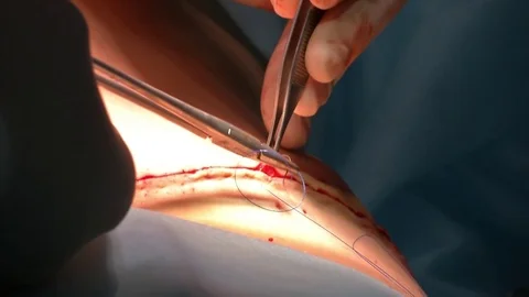 Mastership of the surgeon in the operation. Stock Footage 83192602