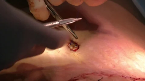 Mastership of the surgeon in the operation. Stock Footage 83192658
