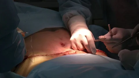 Mastership of the surgeon in the operation. Stock Footage 83192786