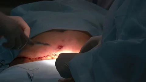 Mastership of the surgeon in the operation. Stock Footage 83194725