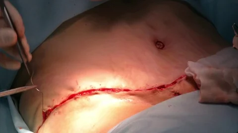 Mastership of the surgeon in the operation. Stock Footage 83195082