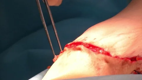 Mastership of the surgeon in the operation. Stock Footage 83195413