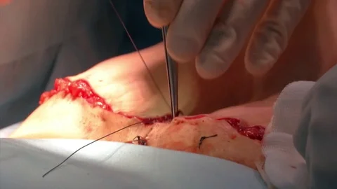 Mastership of the surgeon in the operation. Stock Footage 83197481