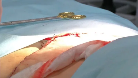 Mastership of the surgeon in the operation. Stock Footage 83770455