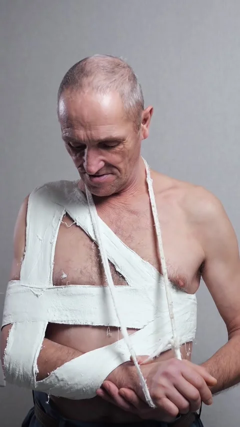 Mature man with a broken arm and shoulder in a plaster cast standing with a sad Stock Footage 340846527