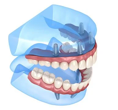Maxillary and Mandibular prosthesis with gum All on 4 system supported by imp Stock Illustration