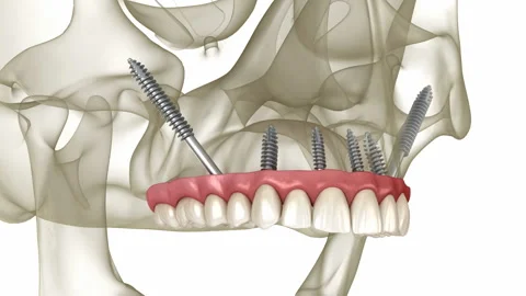 Maxillary and Mandibular prosthesis supp... | Stock Video | Pond5