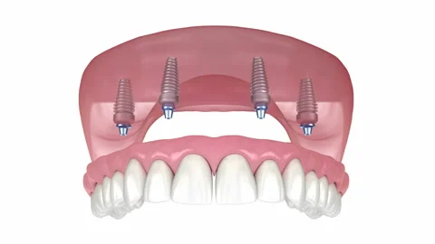 Maxillary prosthesis All on 4 system supported by implants Stock Footage 129303316