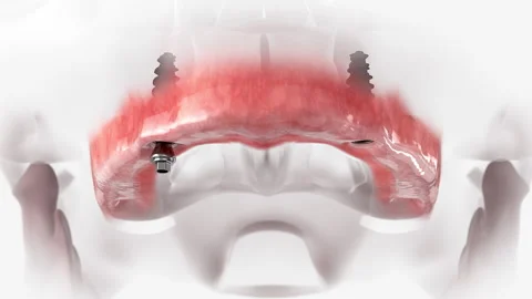 Maxillary prosthesis Stock Footage 139715044