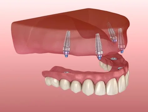 Maxillary prosthesis with gum All on 4 system supported by implants. Medicall Illustrazione stock
