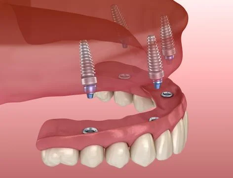 Maxillary prosthesis with gum All on 4 system supported by implants. Medicall Stock Illustration