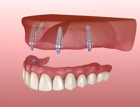 Maxillary prosthesis with gum All on 4 system supported by implants. Medicall Illustrazione stock