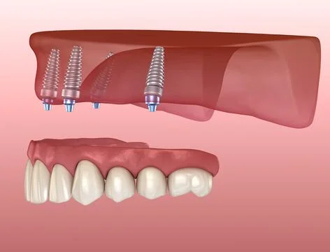 Maxillary prosthesis with gum All on 4 system supported by implants. Medicall Stock Illustration