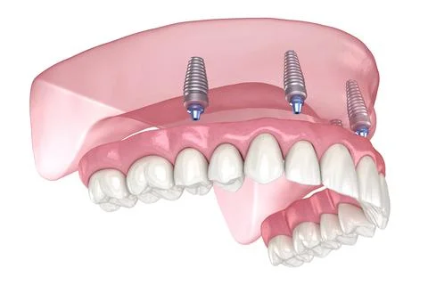 Maxillary prosthesis with gum All on 4 system supported by implants. Medicall Ilustração Stock