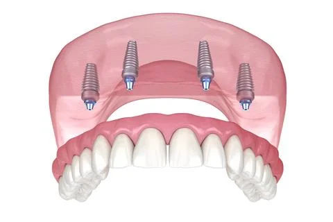 Maxillary prosthesis with gum All on 4 system supported by implants. Stock Illustration